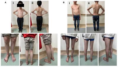 Case Report: A Boy From a Consanguineous Family Diagnosed With Congenital Muscular Dystrophy Caused by Integrin Alpha 7 (ITGA7) Mutation